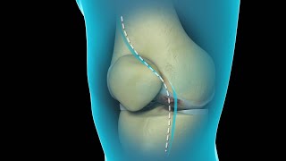 Inside Joint Replacement Surgery Webmd