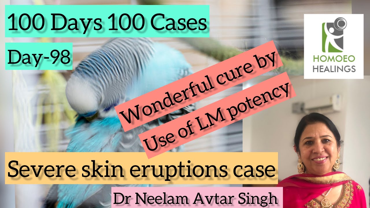 MIRACLE OF LM POTENCY | SEVERE SKIN ERUPTIONS OF SULPHUR | 100 DAY 100 CASES | DAY-98 | VIDEO 270