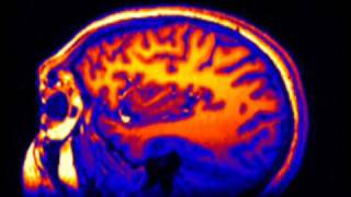 3D MRI of human brain