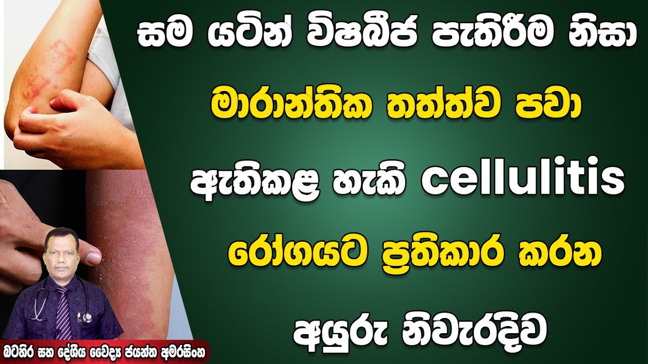සම යටින් විෂබීජ පැතිරීම නිසා මාරාන්තික තත්ත්ව පවා ඇතිකළ හැකි cellulitis රෝගයට ප්‍රතිකාර කරන අයුරු