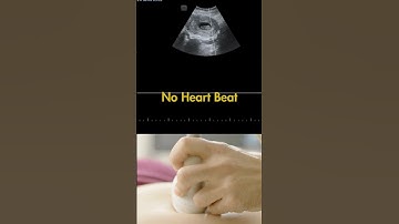 Ultrasound showing a  9 weeks fetus with no Heart Beat