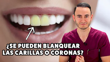 ¿La pasta de dientes blanqueadora daña las carillas?