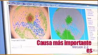 Cancer de Piel Clinica Las Condes
