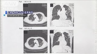 ぜんそく治療薬が効果か「感染者3人の症状改善」(20/03/03)
