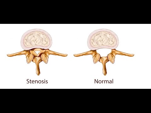 Review Icd 10 Scoliosis