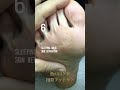 【魚の目特集】足裏の魚の目【用賀フットケア】#魚の目 #フットケア #鶏眼