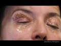 Blepharoplasty by PLEXR Plasma