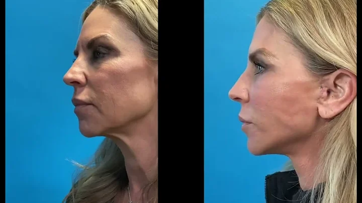 Advanced Facelift Dynamic Photos from Advanced Facelift Before & Afters