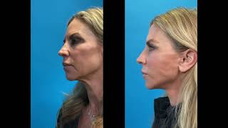 Advanced Facelift Dynamic Photos From Advanced Facelift Before Afters