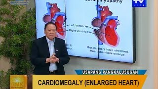 Good Morning Kuya: Cardiomegaly (Enlarged Heart)