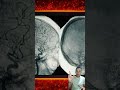 Coma ou morte cerebral?