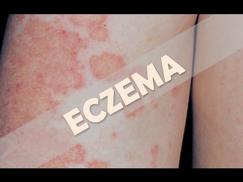 Vídeo: Cicatrices De Eccema: 10 Remedios Caseros Para Probar