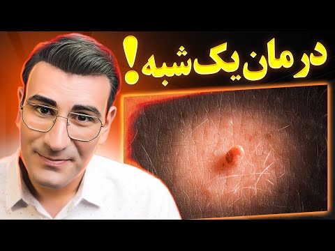 از بین بردن یک شبه زگیل ها و منگوله های پوستی در خانه       