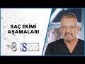 Saç Ekimi Aşamaları | Dr. Koray Erdoğan | 8'de Sağlık