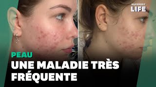 Quest Ce Que Lacné Rosacée Dont Souffre Enjoyphoenix?