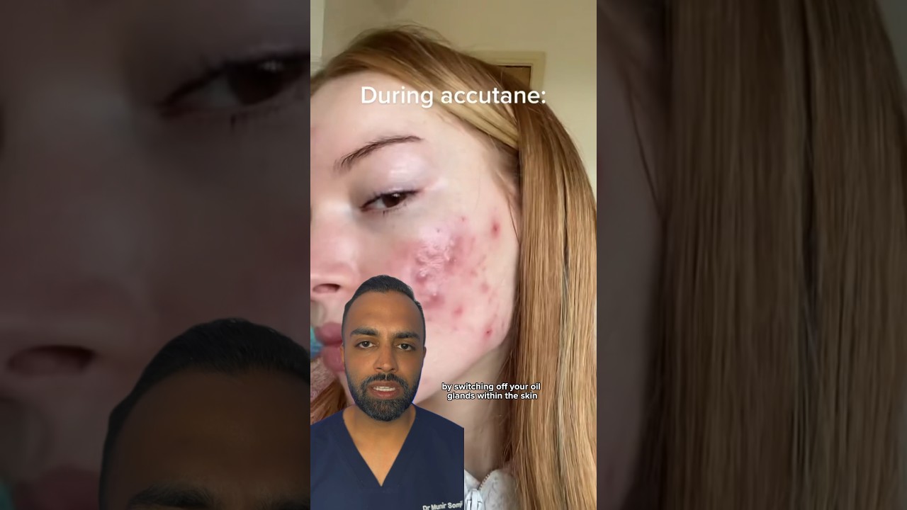 How does ACCUTANE work? Dr Somji Explains