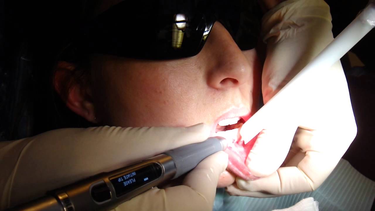 Laser Frenectomy with Flagstaff Dentist John L. Bacon D.D.S. YouTube