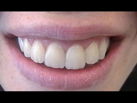 Dis Eti Estetigi Dentorama Ozel Kavacik Dis Klinigi Beykoz