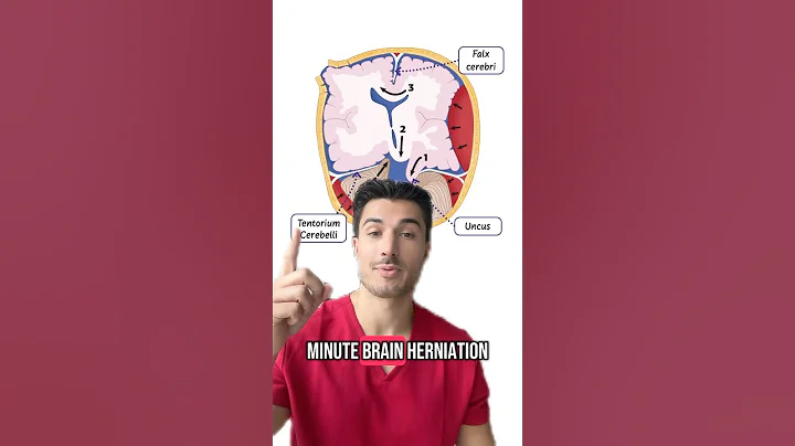Let’s breakdown Brain Herniations 🧠🩸#medstudent #medschool #usmle #usmlestep1 #neurology