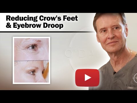 BOTOX for Eyes