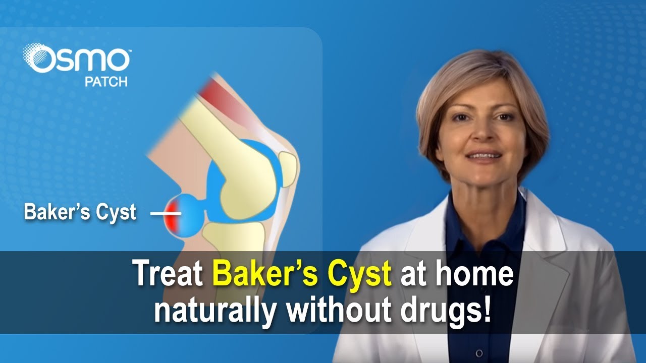 Baker's Cyst Treatment - (Drug Free relief of pain & inflammation