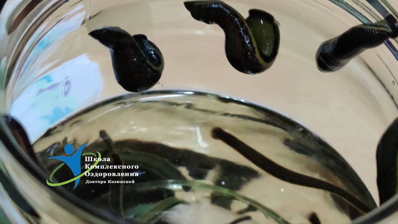 Ставить или нет пиявки при ожогах? 😳