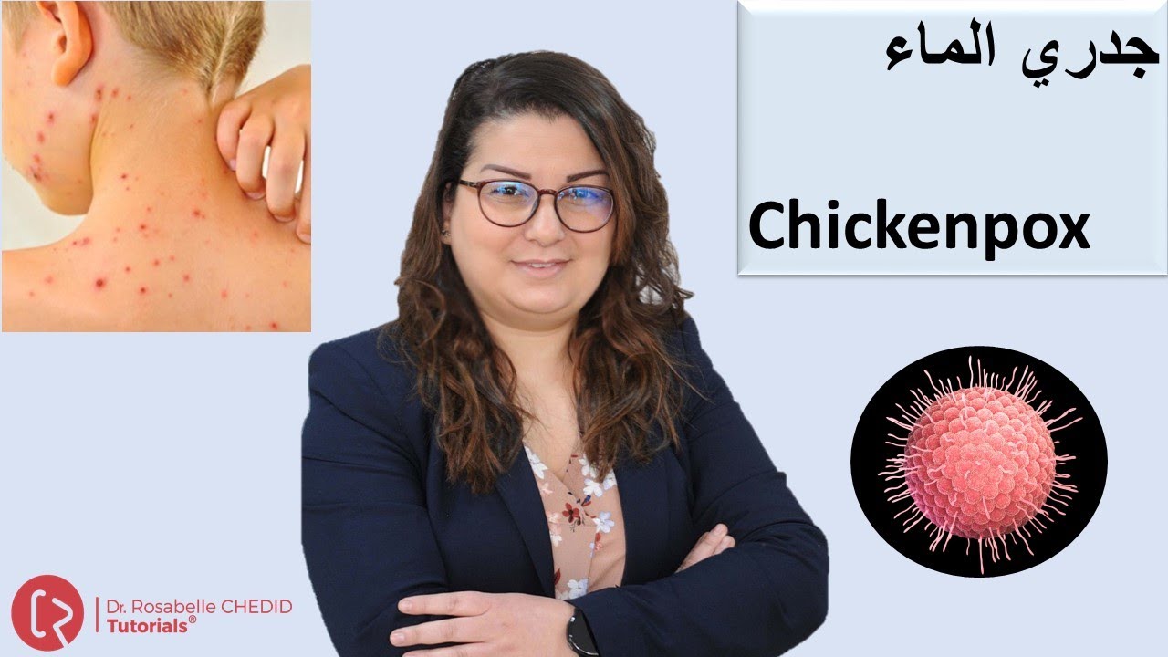 What is Chickenpox? | ما هو جدري الماء؟ - YouTube