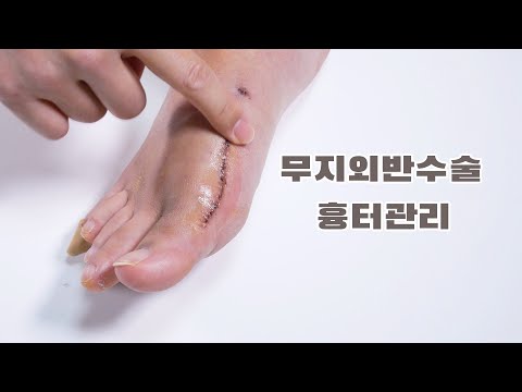 [무지외반증&소건막류 수술후기] Ep.41 흉터관리 시작합니다