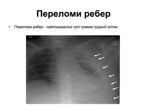 тема 15 Травма грудной клетки