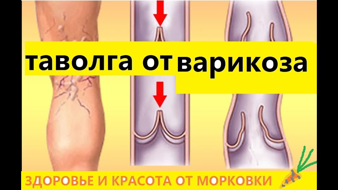 таволга вязолистная лечит варикозное расширение вен - YouTube