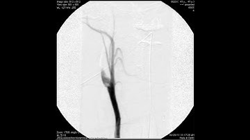 spontaneous arterial dissection