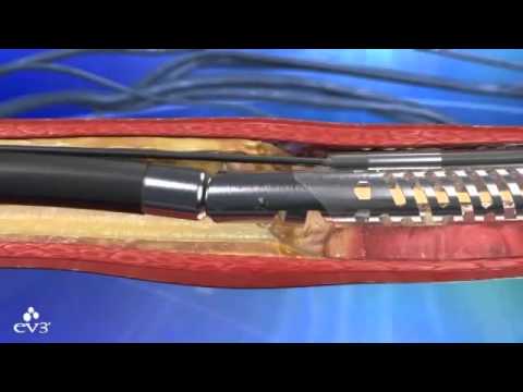 removal plaque clot blood report cholesterol special systems