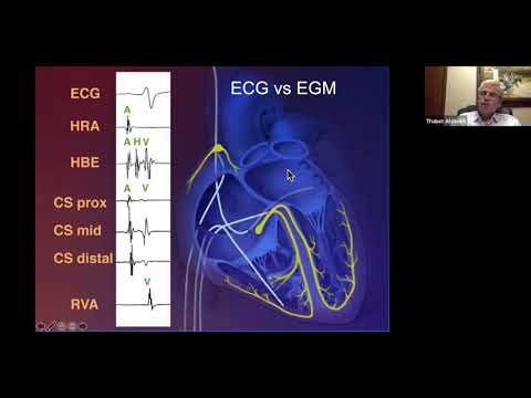 From Surface ECG to Intracardiac EGM  Part 1