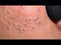 [ASMR] Blackhead Removal &amp; Skin Smoothing Routine