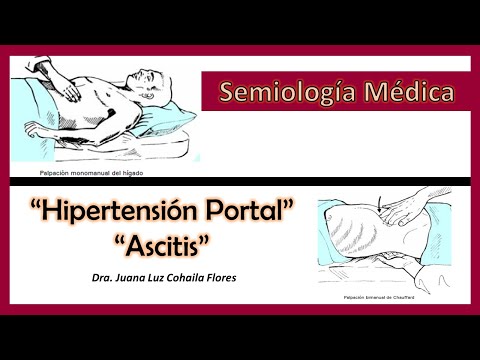 Hipertension Portal y Ascitis 1