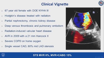 Transseptal transcatheter mitral valve replacement in severe mitral annular calcification