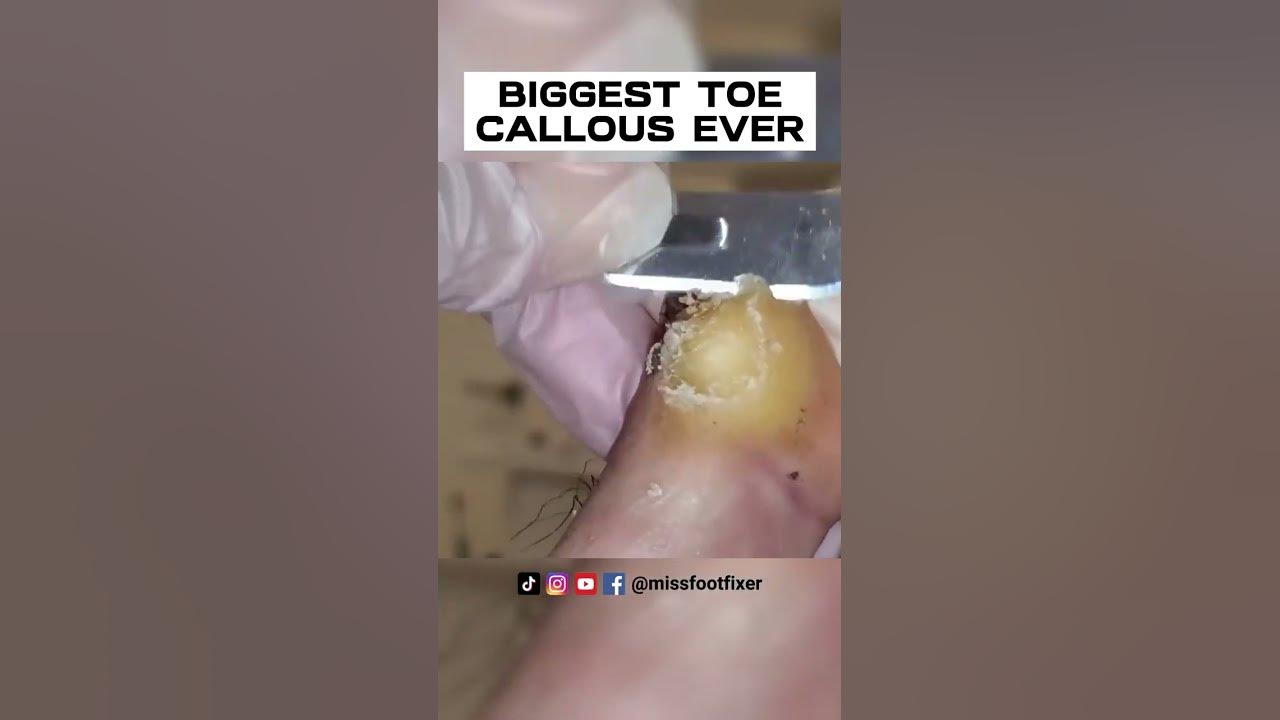 SHAVING OF REAL BIG TOE CALLUS 🦶 BIGGEST TOE CALLOUS EVER FULL