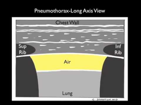 Video: Pneumotorax Pľúc