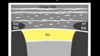 How To: Ultrasound for Pneumothorax Case Study Video