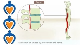 Sciatica - StoryMD