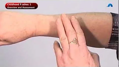 Jak se léčí petechie?