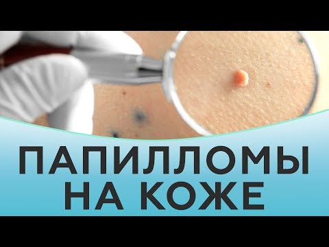 Папилломы на коже. Что нужно знать о папилломах?