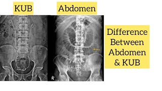 Abdomen Kub x ray | Difference between abdomen and Kub | @scparamedicalinstitute8221