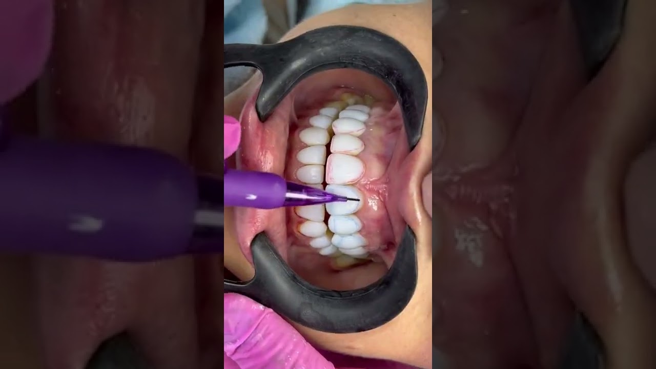 Áreas de espelho: como aumentar e diminuir dentes com ilusão de ótica nas resinas compostas 