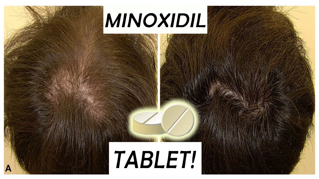 Minoxidil Tablets replacement for 5% Minox!?Pros & Cons. Episode 1 YouTube