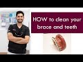 HOW to clean your brace and teeth  |  Dr. Jiten Vadukul  |  The Orthodontist