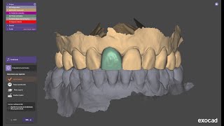 Exocad / Efecto espejo en incisivo central