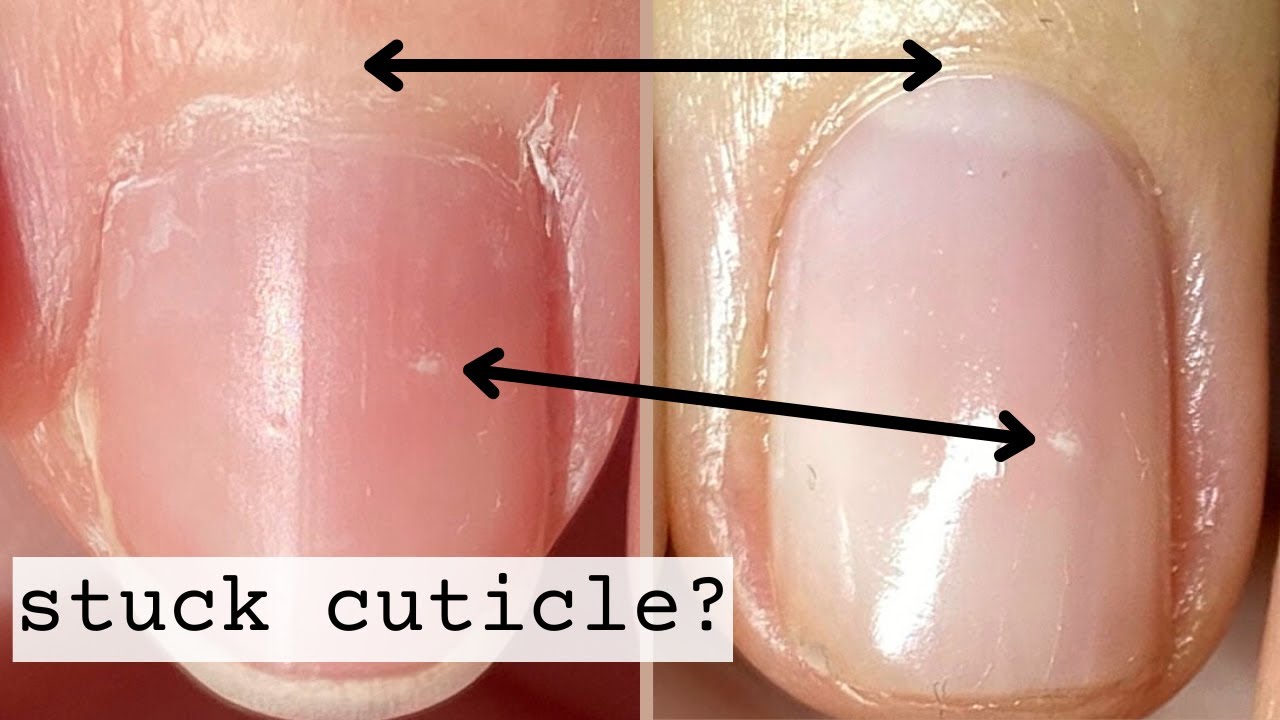 How to remove the dead skin near the side of nails - Quora