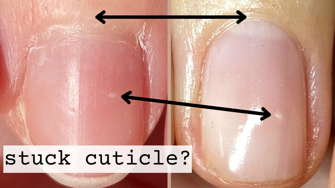 Dry Skin Around Nails: You Need More Than Just Manicure!