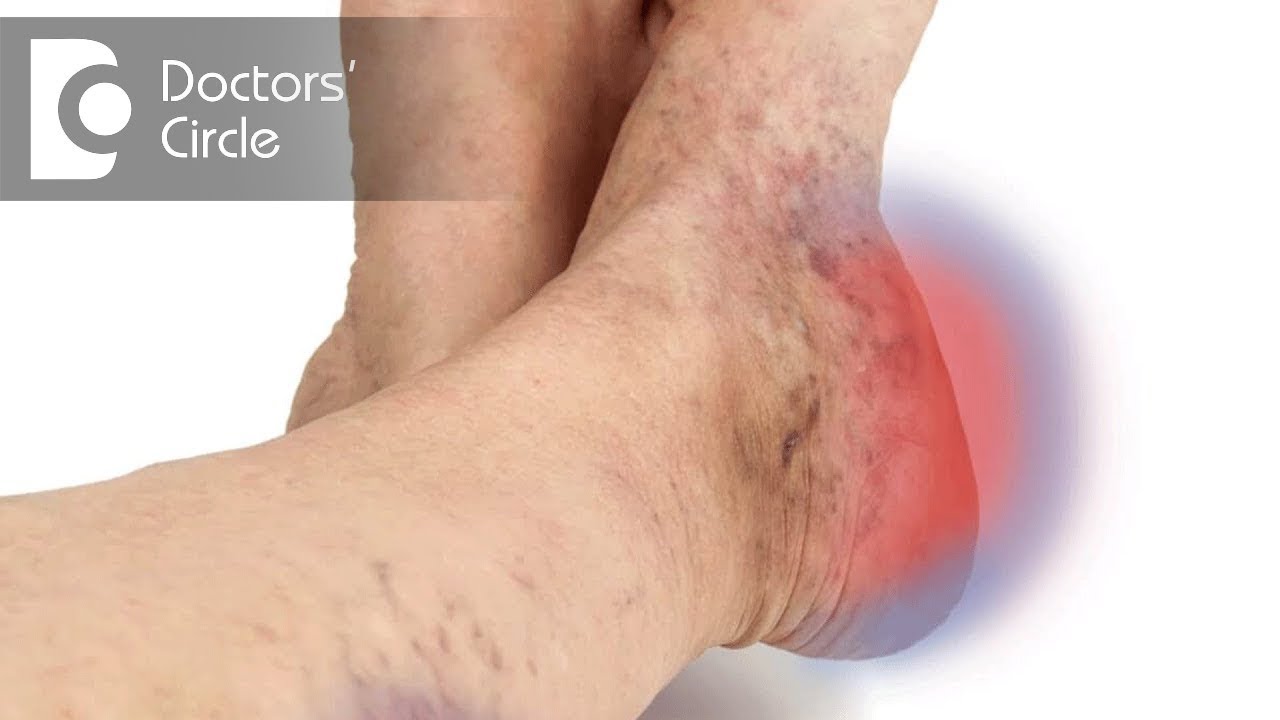 What causes non healing ulcer & its management? – Dr. Narendra Kumar Reddy